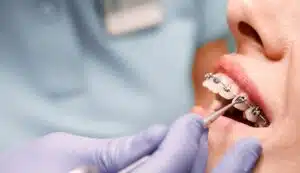 Structure of metal braces