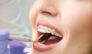 of metal braces