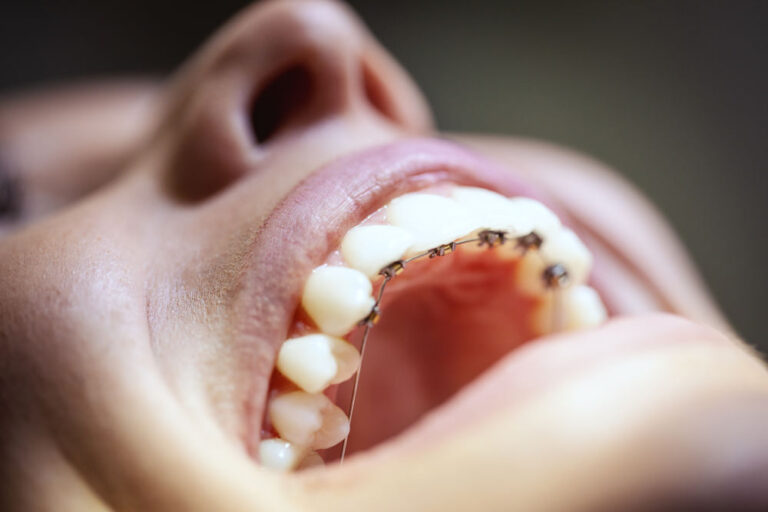 Lingual Braces in Ringwood