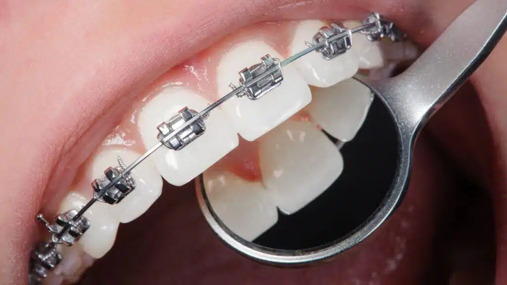 What is the Average Cost for Orthodontic Braces in 2025?