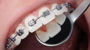 What is the Average Cost for Orthodontic Braces in 2025?
