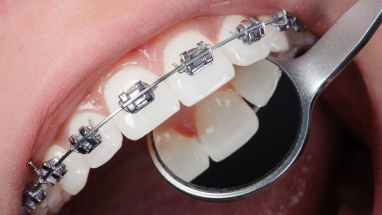What is the Average Cost for Orthodontic Braces in 2025?