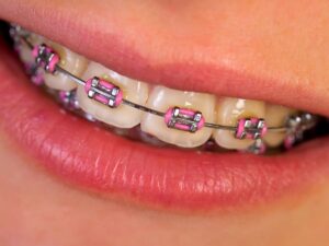 Caring for Colored Braces