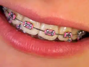Caring for Colored Braces