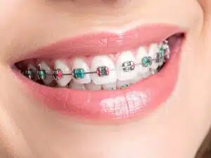 Best braces Color Options