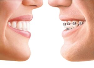 Comparison of teeth with and without braces