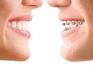 Comparison of teeth with and without braces
