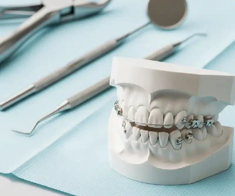 Dental model showing severe teeth crowding and bite misalignment