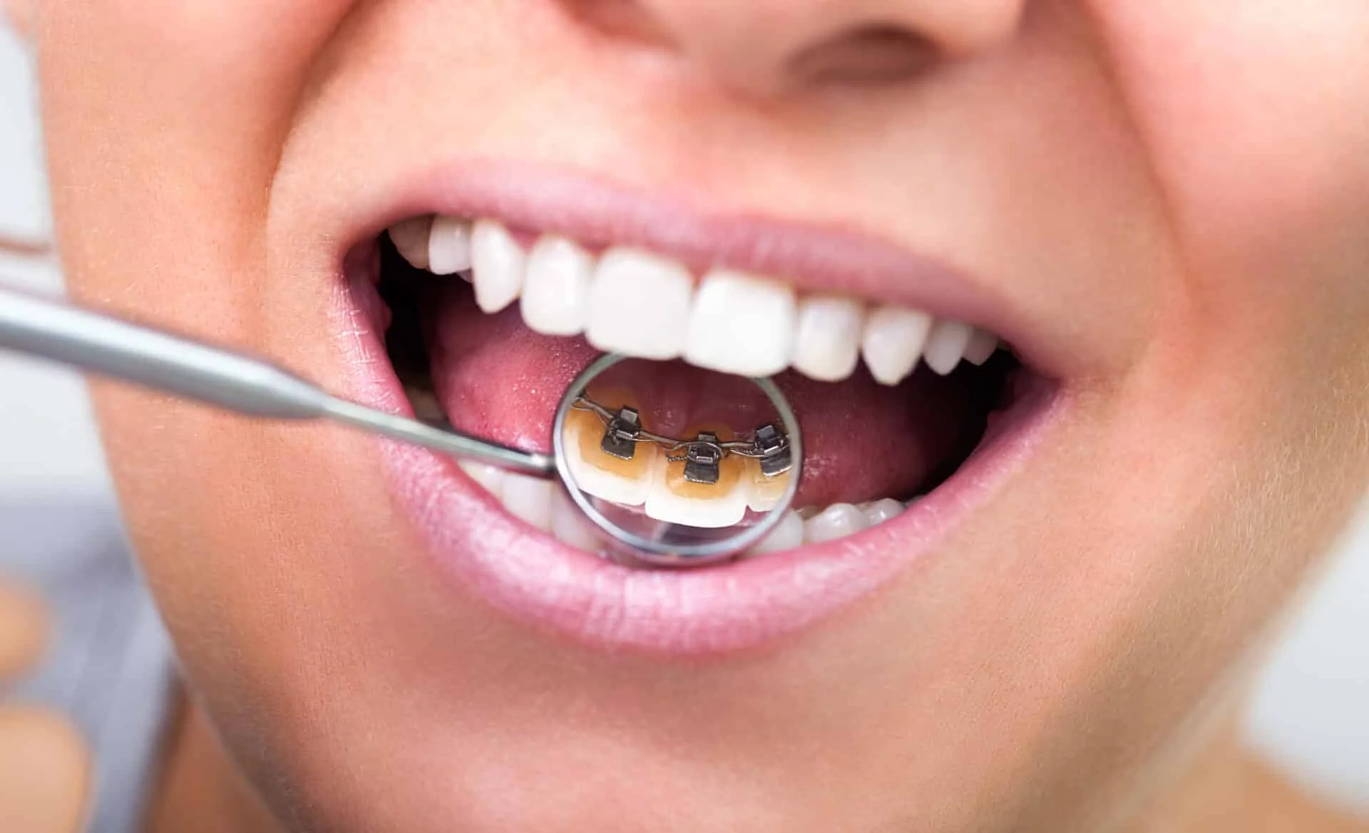 Lingual Braces in Ringwood
