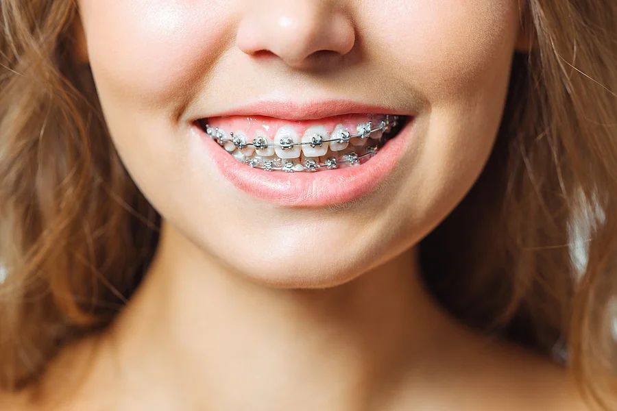 Patient adjusting to braces during the first week